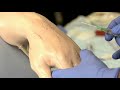 How to Insert a Peripheral IV | Merck Manual Professional Version
