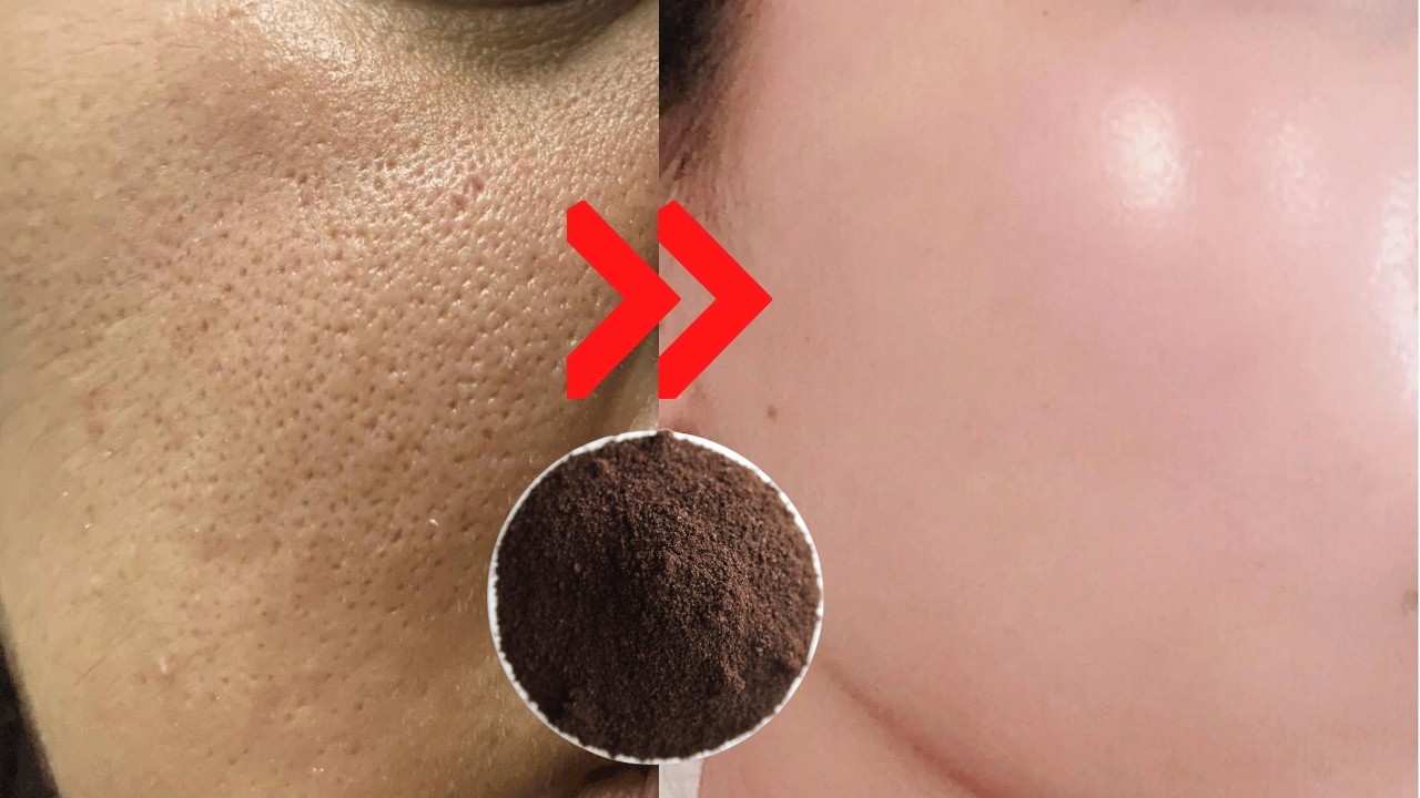 🌹How to Get Rid of Large OPEN PORES Permanently in just 3 days, Get Glass skin!!!