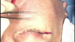 Lower Lid Blepharoplasty Facial Surgery