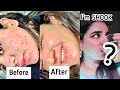 I DRANK THIS for 30 days & it CLEARED my SKIN! (before & after)