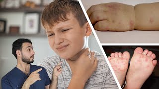 طفح جلدي في اليد و القدم عند الأطفال - مرض اليد و القدم و الفم