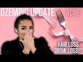 8 MONTH OZEMPIC (SEMAGLUTIDE) UPDATE | DRASTIC HAIRLOSS &amp; ACNE! :( | Paulina Schar