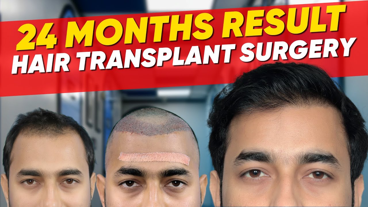 Hair Transplant in Bhubaneswar Best Results & Cost of Hair Transplant