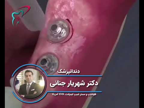 درمان لق شدن ایمپلنت دندان