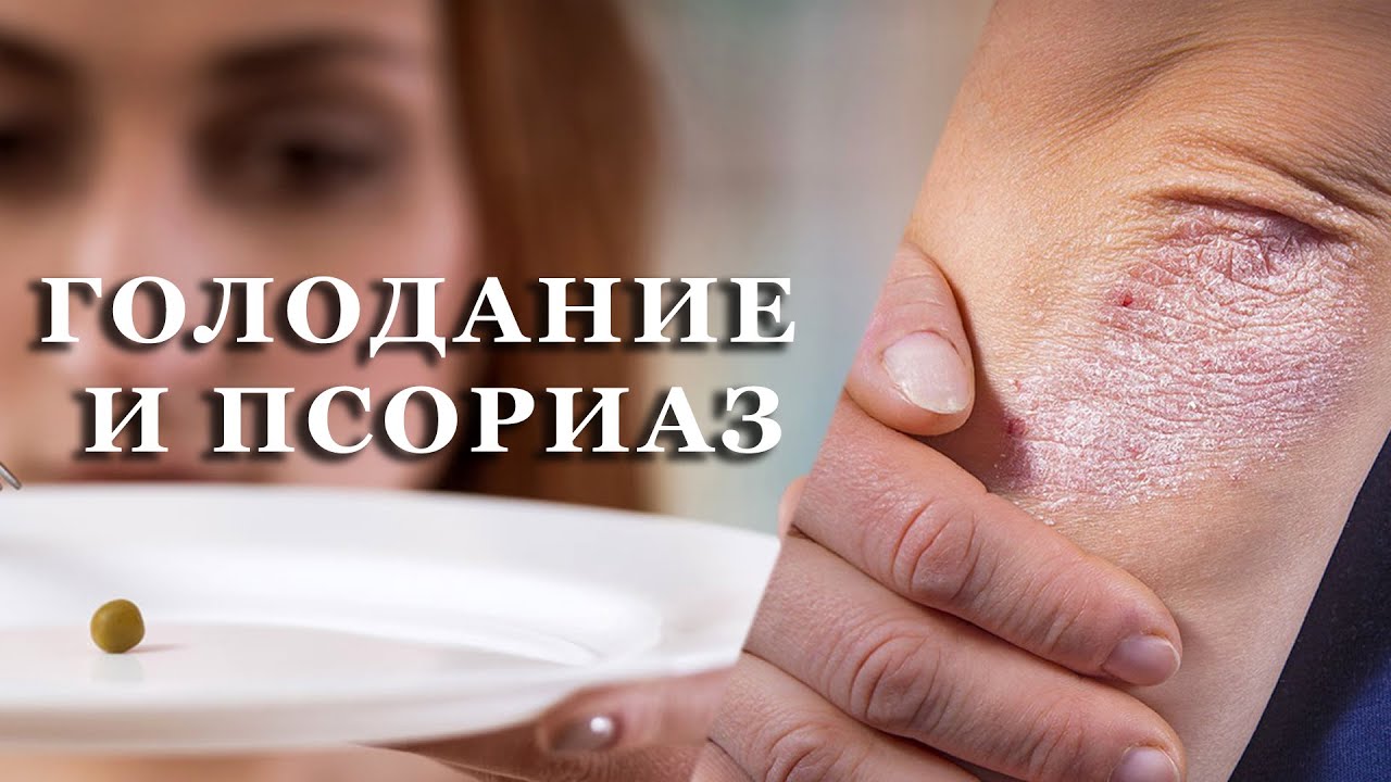 ГОЛОДАНИЕ И ПСОРИАЗ #PSORIK