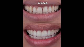 Orthodontic Treatment With Composite Resin Restoration 