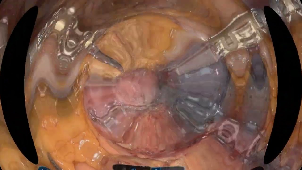 Robotic resection of proximal jejunal adenocarcinoma just distal to ligament of trietz