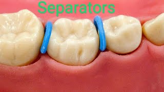 Orthodontic Separators! All you need to know!