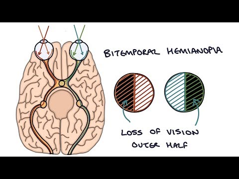 Video: Hemianopia: Definition, Typer, Symptomer, årsager Og Behandling