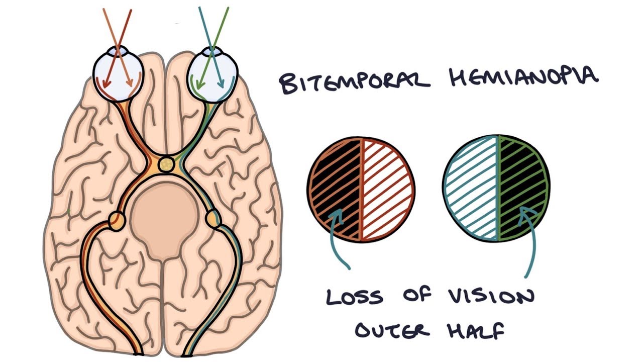 Bilateral Hemianopia Cause