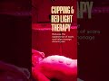 Cupping Therapy + Red Light Therapy