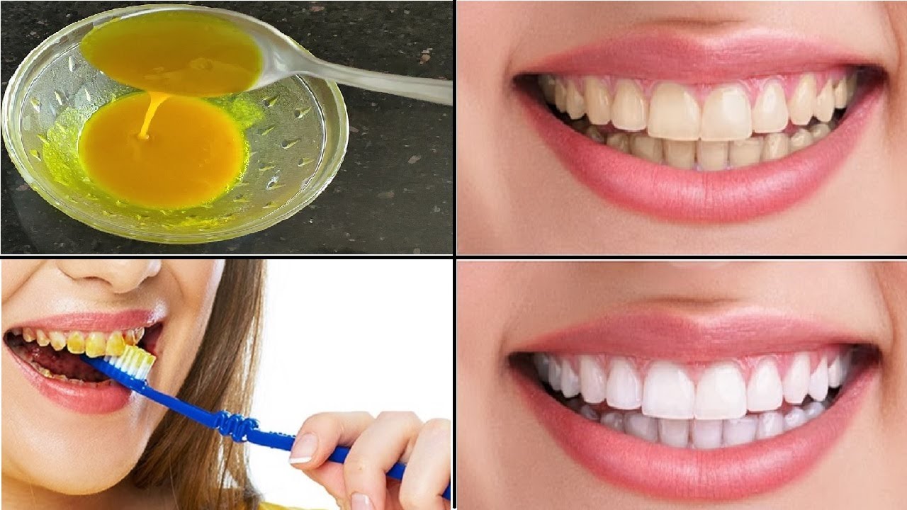 Отбеливания зубов сливочным маслом ирригаторы лучшие по мнению стоматологов