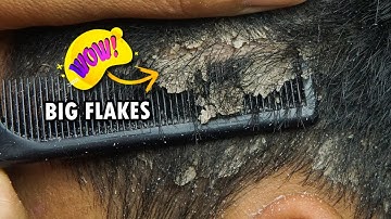 Dandruff Scratching Big Flakes Satisfying #1229