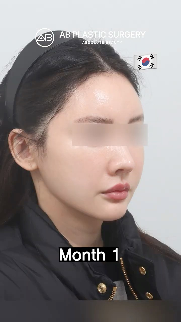 Why Korea Is the Best for Double Chin Surgery #shorts