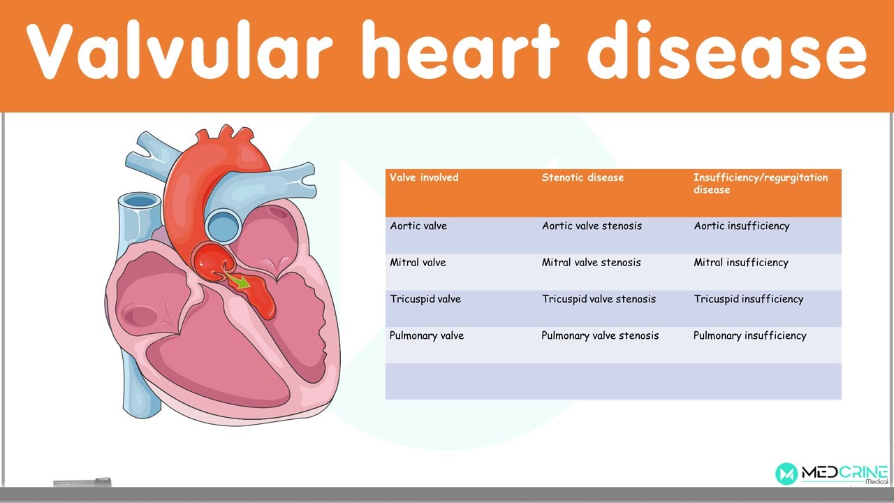 Valvular Heart Diseases Classification Causes Pathophysiology
