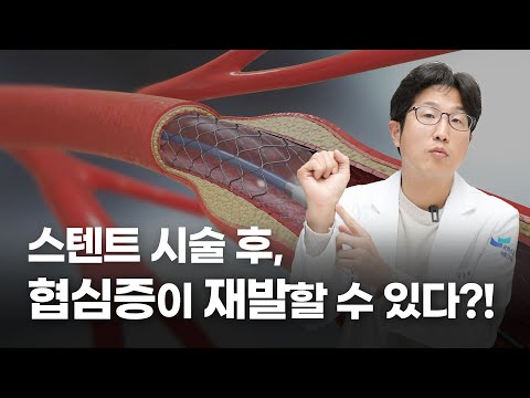 협심증 치료인 스텐트시술, 시술후 재협착의 가능성은?