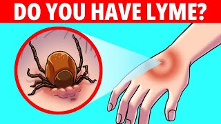 Lyme Disease Symptoms, Testing, and Treatment by The Daily Topic 89 views 1 year ago 8 minutes, 19 seconds