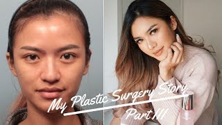 MY PLASTIC SURGERY STORY (PART 3) END RESULT! (ENG SUB) BAHASA INDONESIA