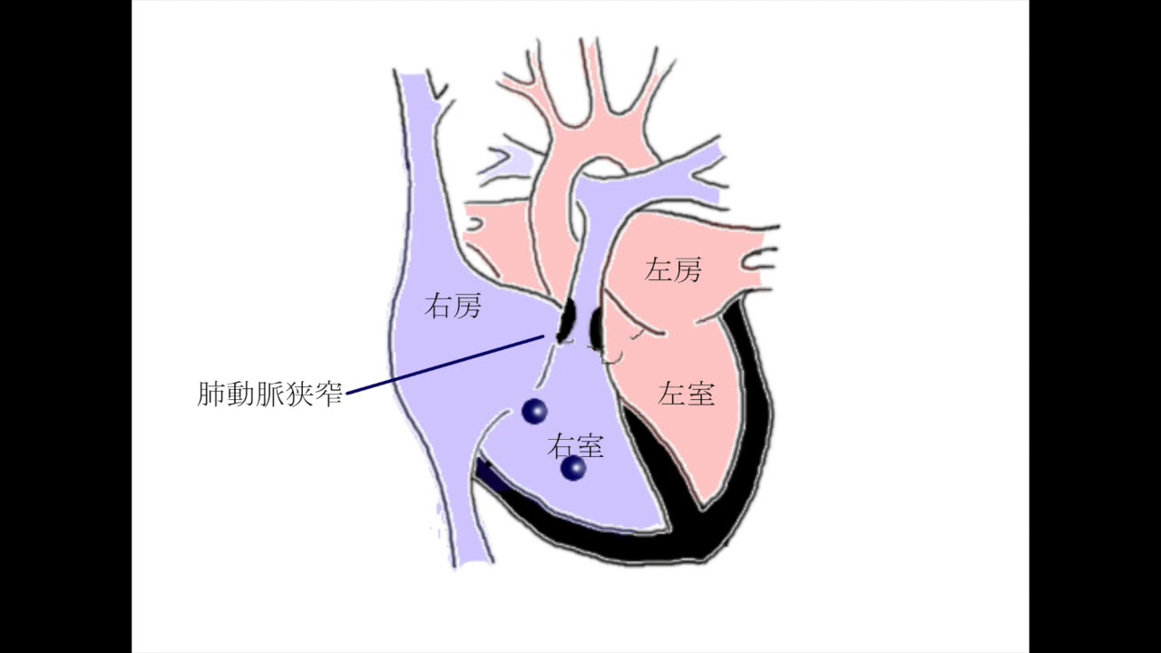 肺動脈 狭窄 症