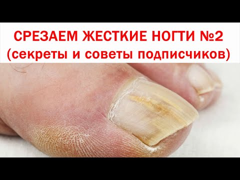 ОЧЕНЬ МНОГО СЕКРЕТОВ как постричь толстые и жесткие ногти на ногах. Узнайте, как размягчить ногти.
