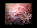 THORACIC PART OF ROBOTIC IVOR LEWIS ESOPHAGECTOMY