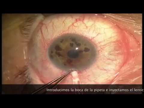 Vídeo: Histopatología De Una Membrana Retrocorneal Después De La Queratoplastia Endotelial De Membrana Descemet: Reporte De Un Caso