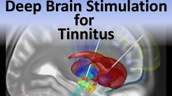 🕱 Deep Brain Stimulation (DBS) 🕱 for Tinnitus