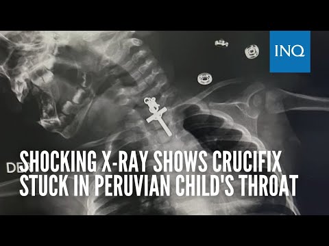 Shocking X-ray shows crucifix stuck in Peruvian child's throat