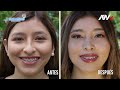 🌟MARAVILLOSO CAMBIO DE DAYANNA GRACIAS A UNA RINOSEPTOPLASTÍA LÁSER  Dr. Iván Guanilo👨🏻‍⚕️