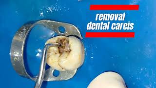 ازالة تسوس عميق بالضرس||deep dental careis #dr_abdullah_sultan_dentist