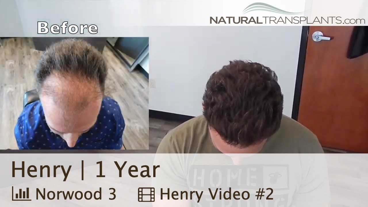 fue hair transplant month by month Hairline Surgery Before and After | Hairline Surgery Results (Henry)