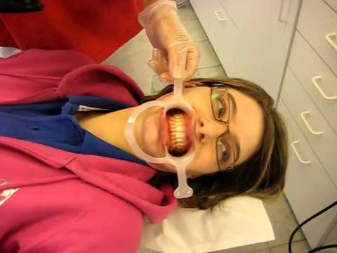 Video: Tandhypoplasie: Behandeling, Oorzaken, Foto's, Vormen
