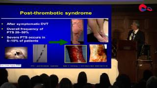 The global burden of VTE