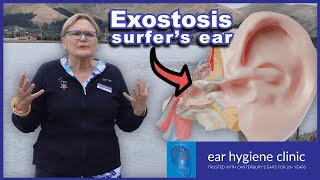 Exostosis - Surfer's Ear