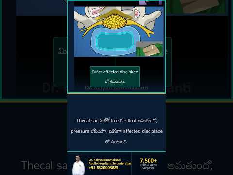 Migrated Disc Fragment kooda Reach cheyyochu — Best Endoscopic Spine Surgeon, Hyderabad