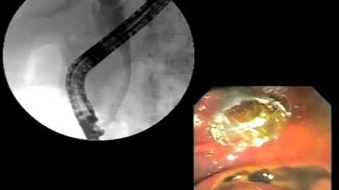 WallFlex® Biliary Metal Stent animation with clinical footage