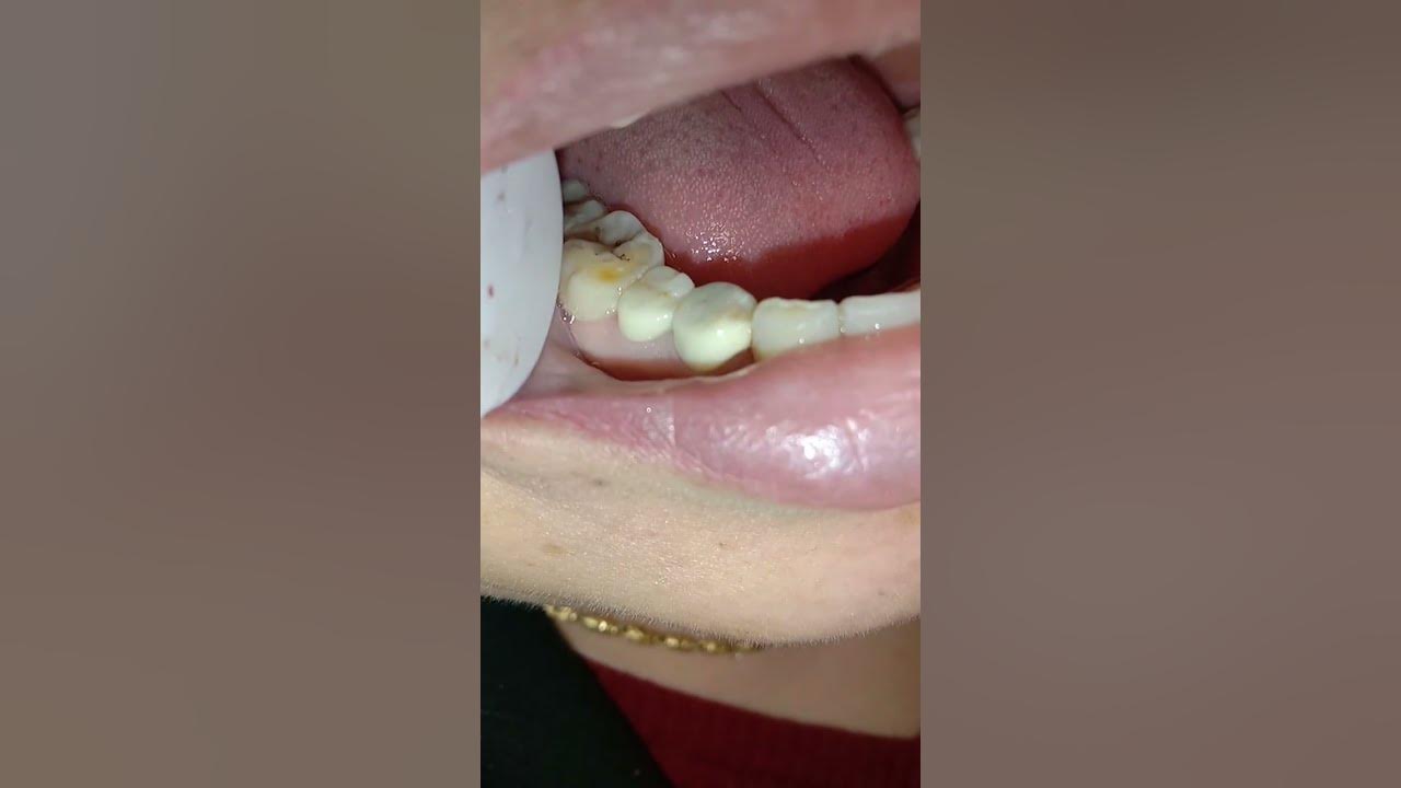 Tooth Filling Cuspid Tooth Extraction Teeth Expander Process