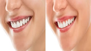 How To Get Rid Of Black Gums Naturally At Home