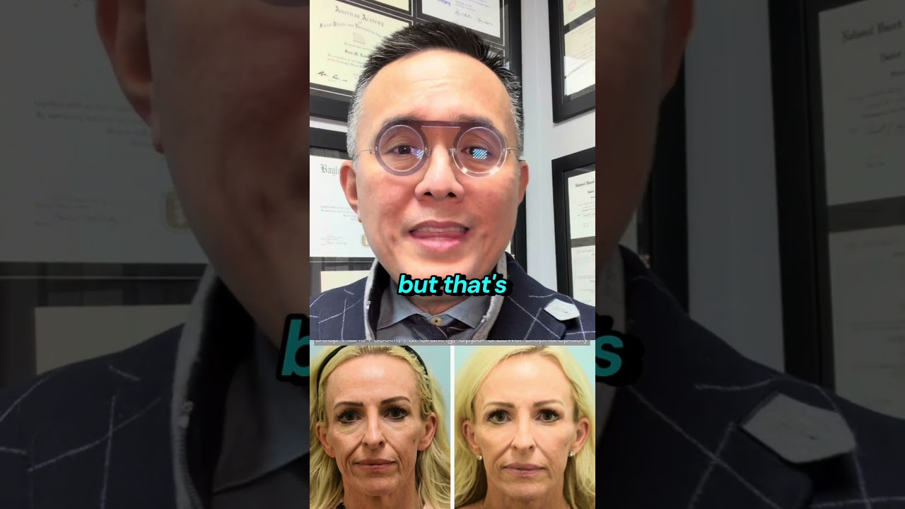 Eyelid Rejuvenation Series Part 6: Why is fat grafting single most important way to rejuvenate eyes