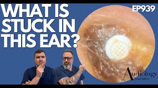 WHAT IS STUCK IN THIS EAR? - EP939