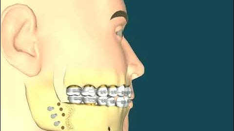 Dental Video for Malocclusion Class II Skeletal - The Tooth