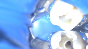 Removal of non visible broken file from buccaly curved apical third. ازاله اداه مكسورة داخل الانحناء