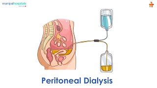 What is Peritoneal dialysis? l Manipal Hospitals Bengaluru