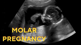 Molar Pregnancy: Understanding the Facts, Risks and Treatment