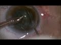 Non dominant hand phaco in soft cataract by adrian gavanescu