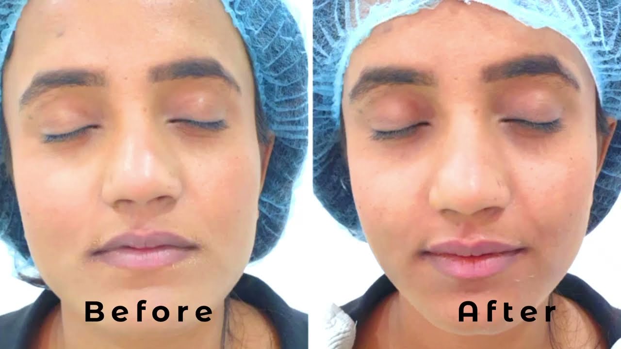 Top 129+ laser hair removal in indore best camera.edu.vn