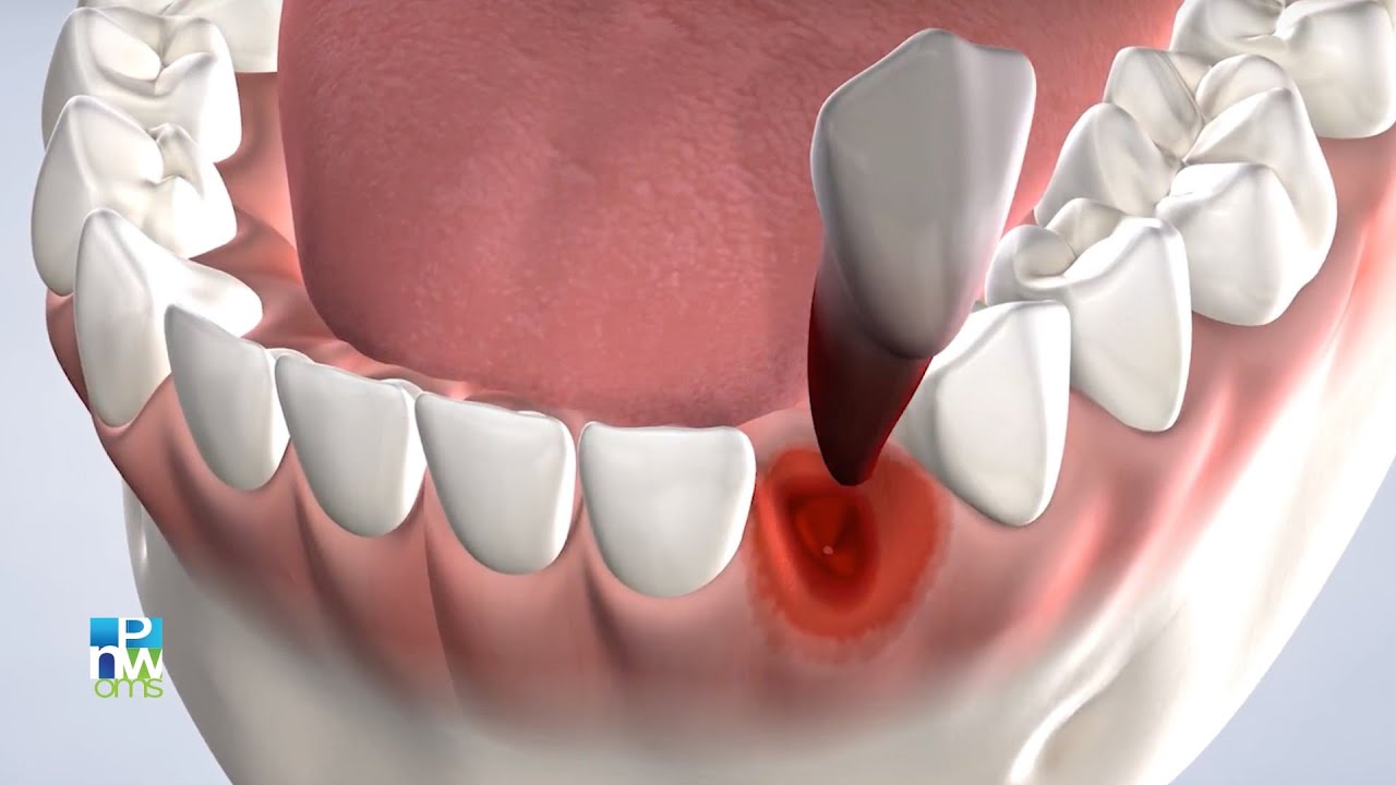 Post-Operatorio: Extracciones Múltiples | Pacific Northwest Oral & Maxillofacial Surgeons