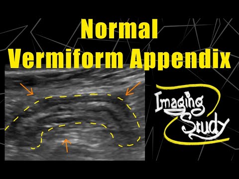Normal Vermiform Appendix