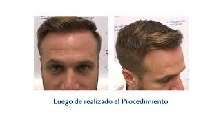 Implante Capilear, Paciente De 38 Años En Clinica Capilea