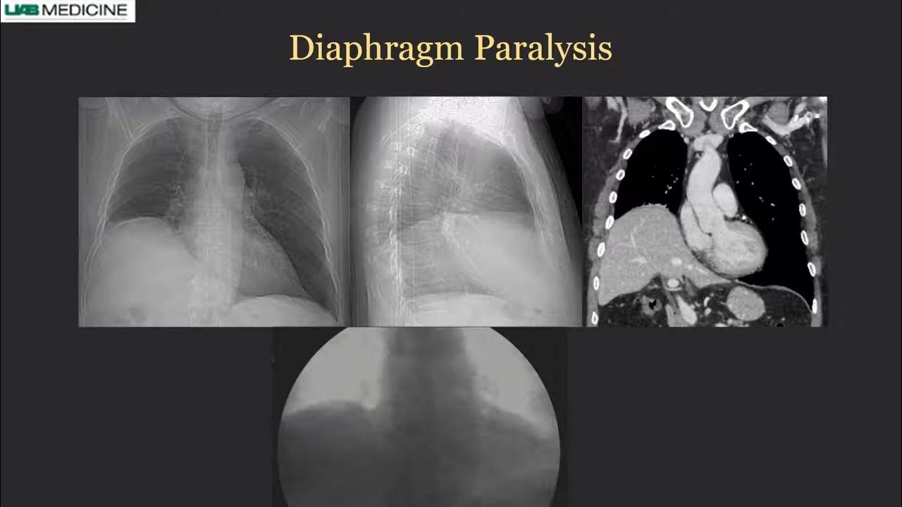 Quantifying Diaphragm Motion Youtube